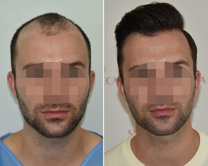 Image of Seneca Hair Transplant Gallery 2