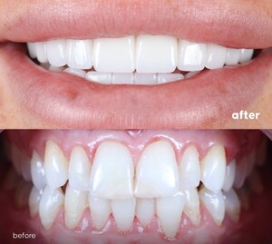 Image of Hollywood smile before and after