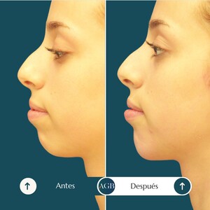 Image of Chin implant