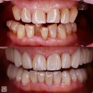 Image of Braces - Delta Clinic Dent