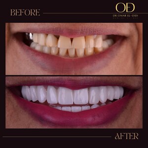 Image of Veneers - Dr. Omar El-Didi 