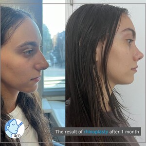 Image of Dr. Rıdvan Büdün- Rhinoplasty Istanbul Gallery 0