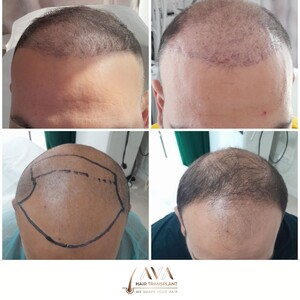 Image of FUE hair transplant - Ava Hair Transplant