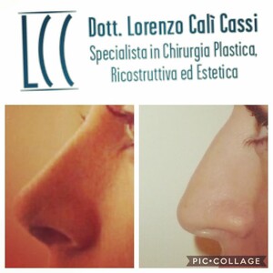 Image of Nose job -  Dr Lorenzo Cali Cassi 