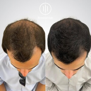 Image of Hair transplantation