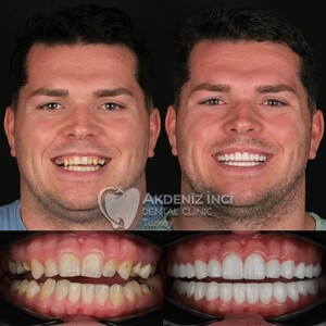 Image of E-max Crowns - Akdeniz Inci Dental Clinic