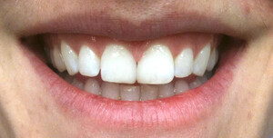 Image of Composite Veneers after