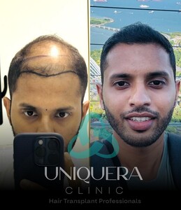 Image of Hair transplant before and after