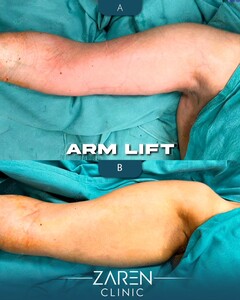 Image of Arm Lift