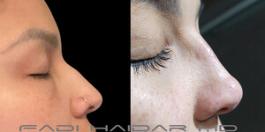 Image of Rhinoplasty