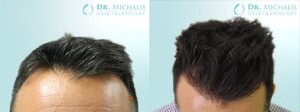 Image of Dr. Michalis Hair Transplant Gallery 0