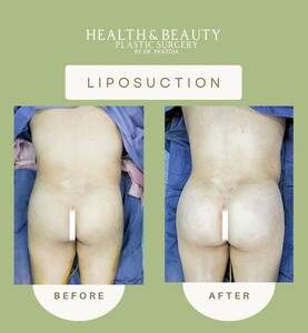 Image of Liposuction