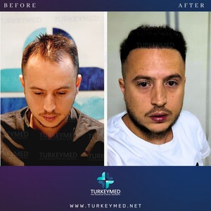 Image of DHI Hair transplant