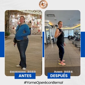 Image of Gastric sleeve before and after