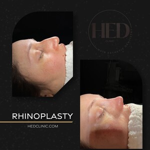 Image of Rhinoplasty before and after