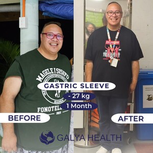 Image of Gastric sleeve before and after