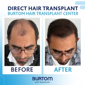 Image of Burtom Hair Transplant Center Gallery 3