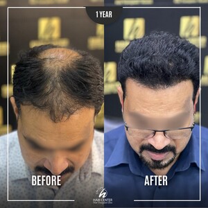 Image of Before and After a Hair Transplant