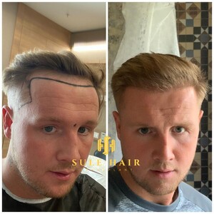 Image of Sule Hair Transplant Gallery 0