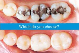 Image of White Fillings