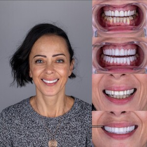 Image of Hollywood smile