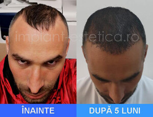 Image of Hair Implant Center Cluj Gallery 3