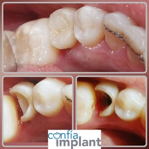 Image of Fillings