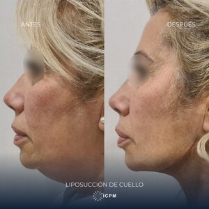 Image of Chin liposuction