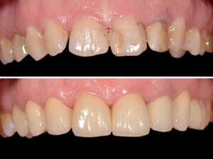 Image of Dental restoration - Pomadent