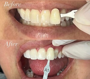 Image of Dental crowns