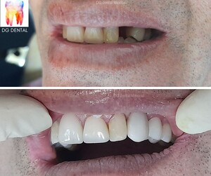 Image of Dental implants