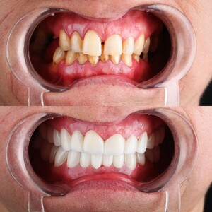 Image of Teeth Whitening - Dr Colic Dental Clinic