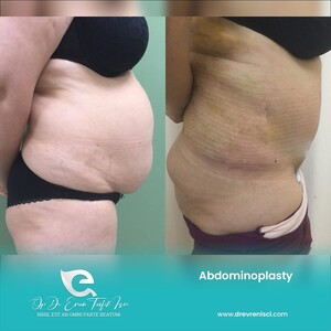 Image of Abdominoplasty