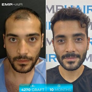 Image of Emphair Hair Transplant Gallery 0