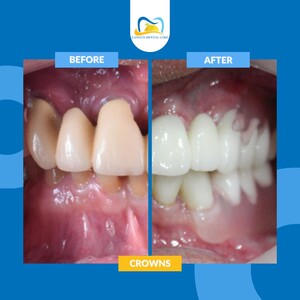 Image of Dental crowns before and after