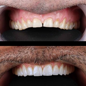 Image of Apex Dental Turkey Gallery 3