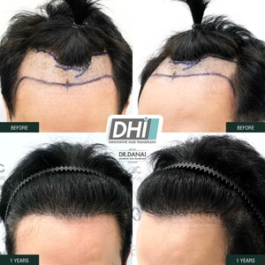 Image of BEQ Clinic - Dr. Danai Bangkok Hair Transplant Gallery 0