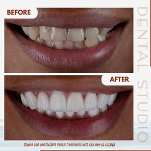 Image of Zirconium veneers before and after