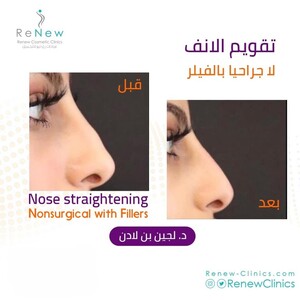 Image of Renew Clinics offers expert rhinoplasty for a refined nose.