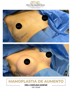 Image of Breast Implant - FMR Clinic 