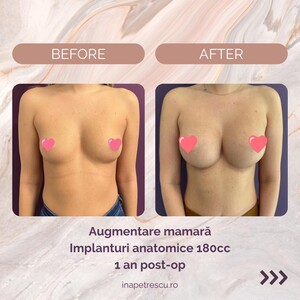 Image of Breast Implant