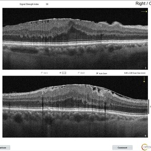 Image of Epiretinal Membrane Peeling BEFORE