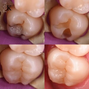 Image of Fillings - Lava Dental