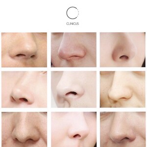 Image of Rhinoplasty - Clinicus