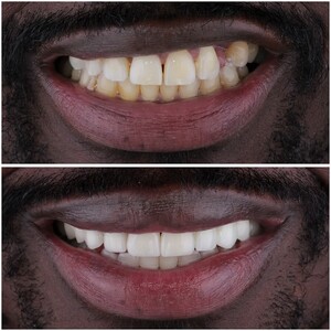 Image of Veneers