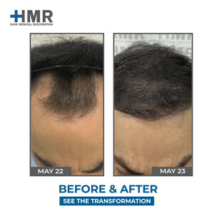 Image of Hair transplant