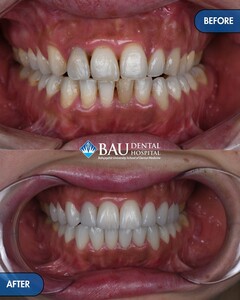 Image of Teeth whitening