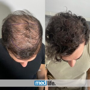 Image of Medlife Group - Hair Transplant Gallery 3