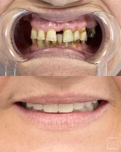 Image of Hollywood smile