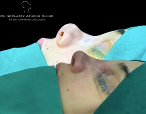 Image of Rhinoplasty Athens Clinic by Dimitris Louloudis Gallery 1